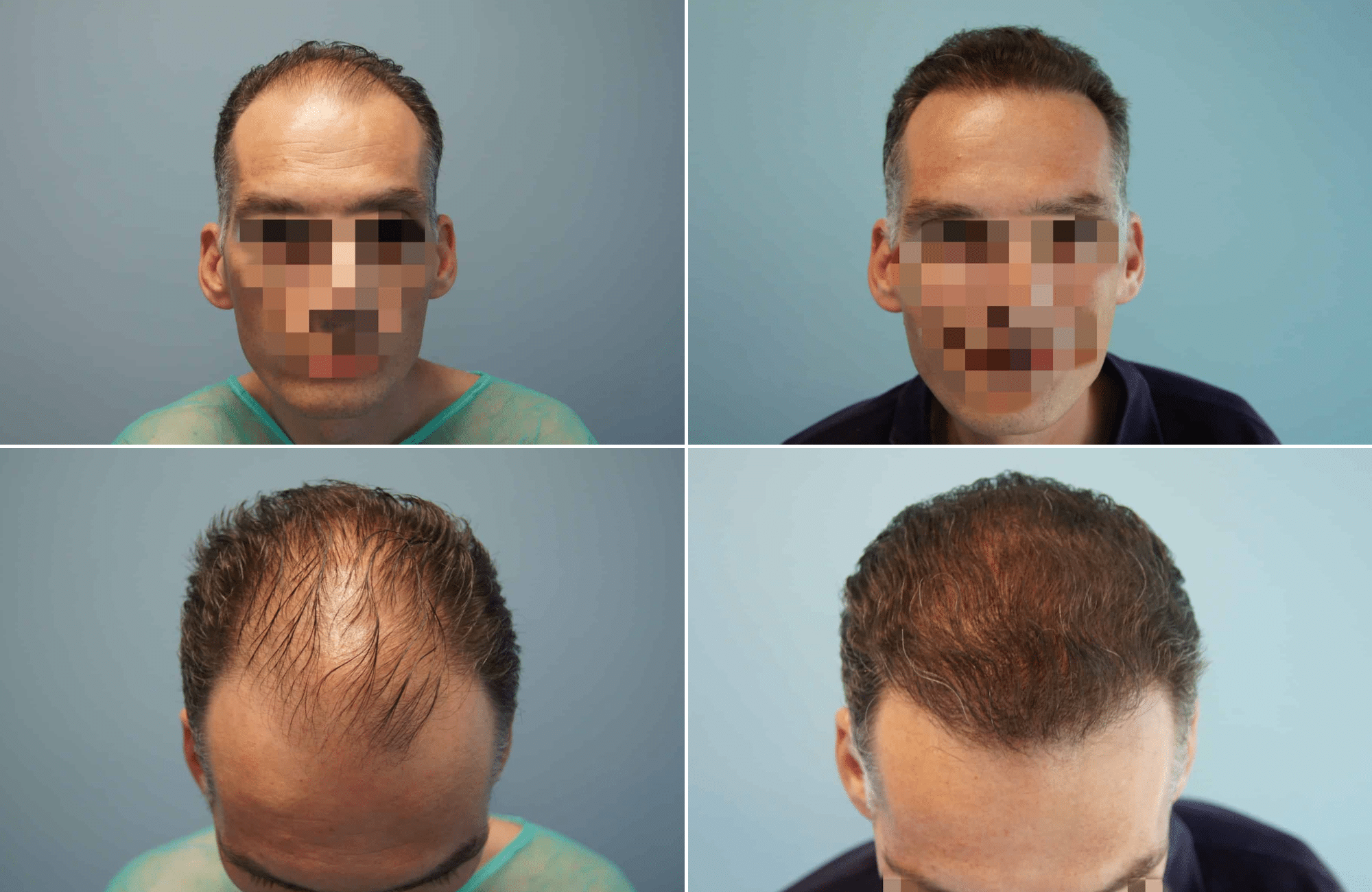 https://anastasakishairclinic.com/portfolio/apotelesma-metamosxefsis-mallion-anastasakis-hair-clinic-43/