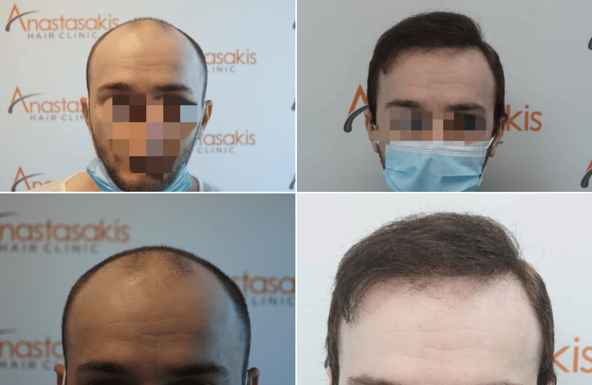 https://anastasakishairclinic.com/portfolio/apotelesma-metamosxefsis-mallion-anastasakis-hair-clinic-219/