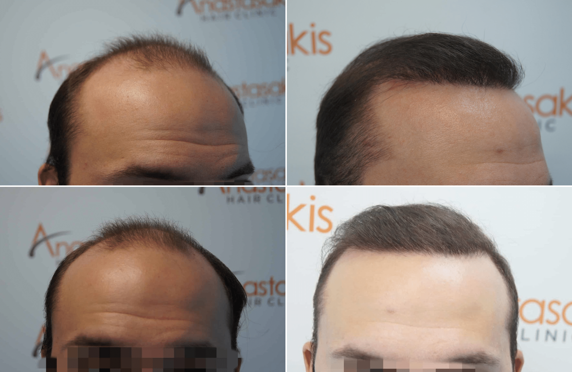 https://anastasakishairclinic.com/portfolio/apotelesma-metamosxefsis-mallion-anastasakis-hair-clinic-223/