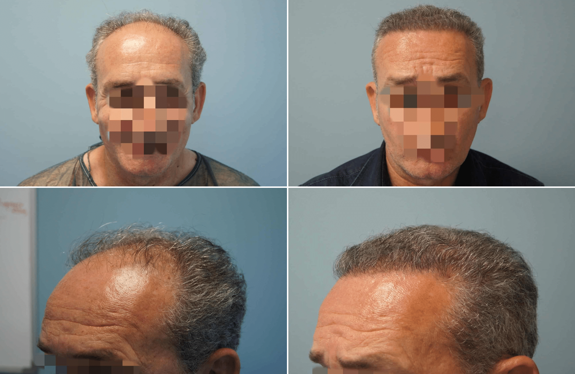 https://anastasakishairclinic.com/portfolio/apotelesma-metamosxefsis-mallion-anastasakis-hair-clinic-227/