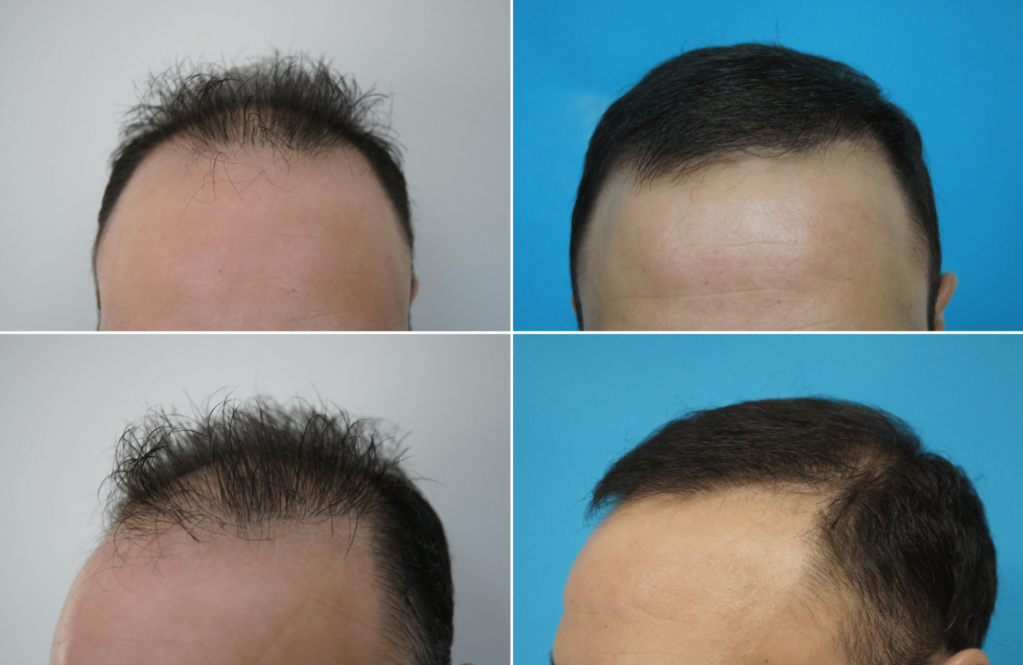 https://anastasakishairclinic.com/portfolio/apotelesma-metamosxefsis-mallion-anastasakis-hair-clinic-183/