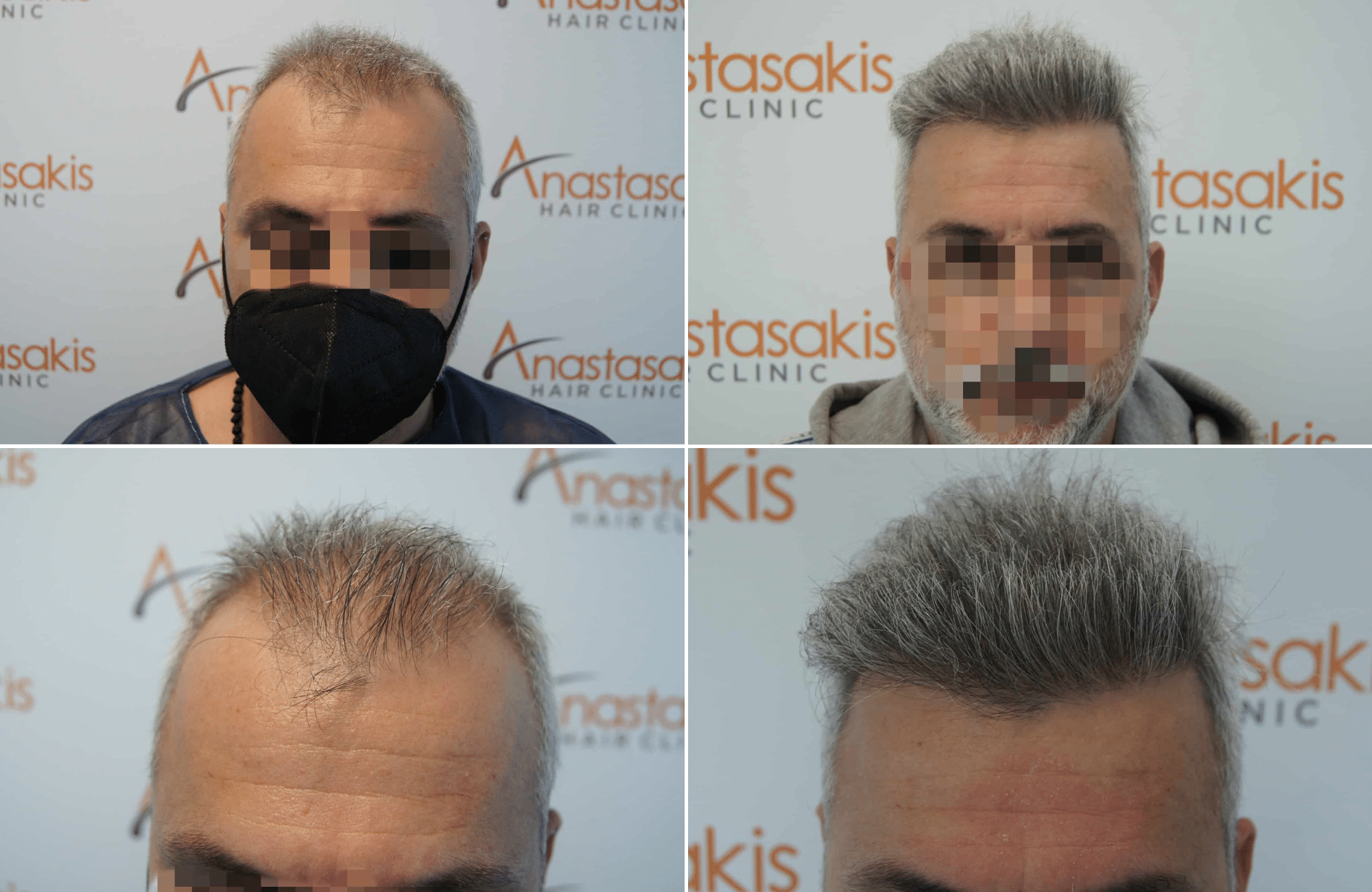 https://anastasakishairclinic.com/portfolio/apotelesma-metamosxefsis-mallion-anastasakis-hair-clinic-25/