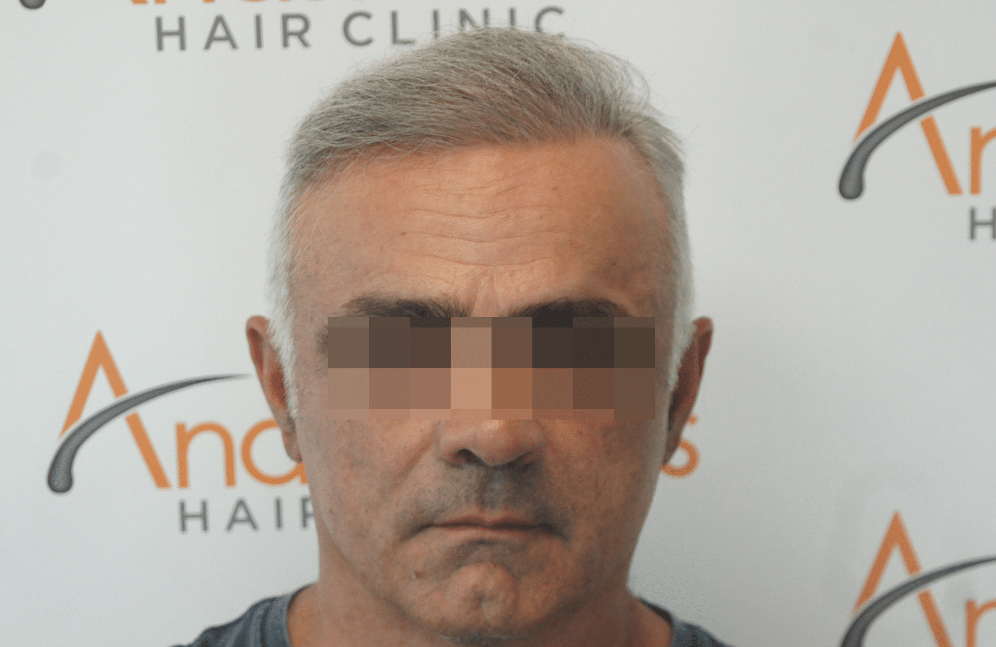 hair transplant result with 2500 follicular units anastasakis hair clinic