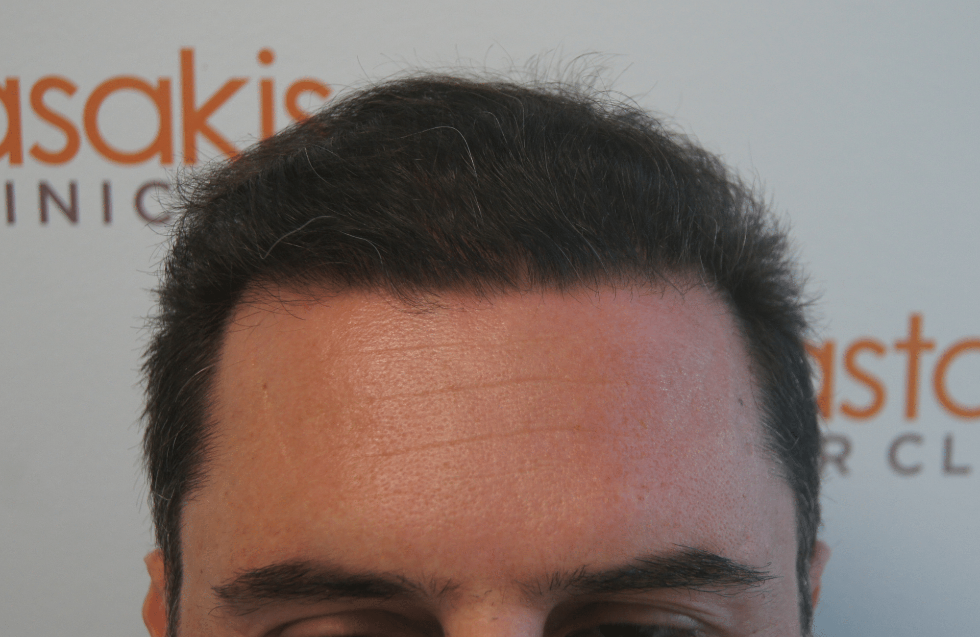 hair transplant result with 3000 follicular units anastasakis hair clinic