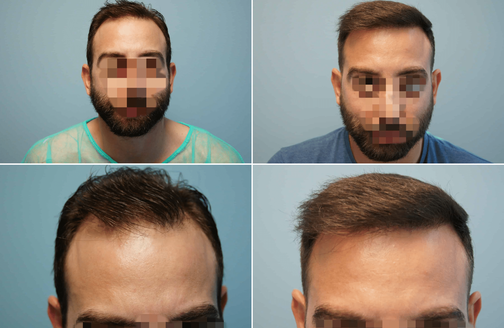 https://anastasakishairclinic.com/portfolio/apotelesma-metamosxefsis-mallion-anastasakis-hair-clinic-51/
