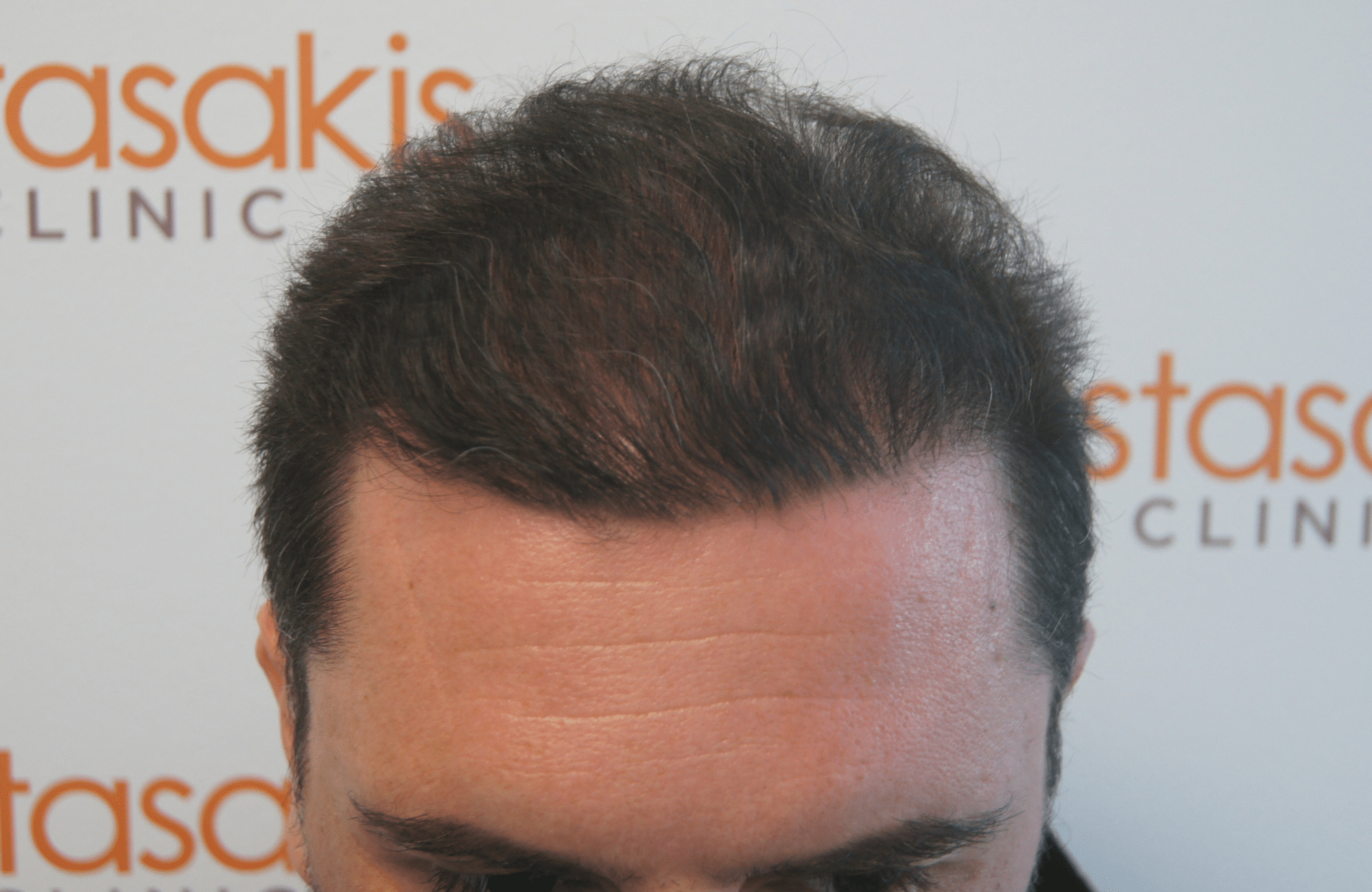 hair transplant result with 3000 follicular units anastasakis hair clinic