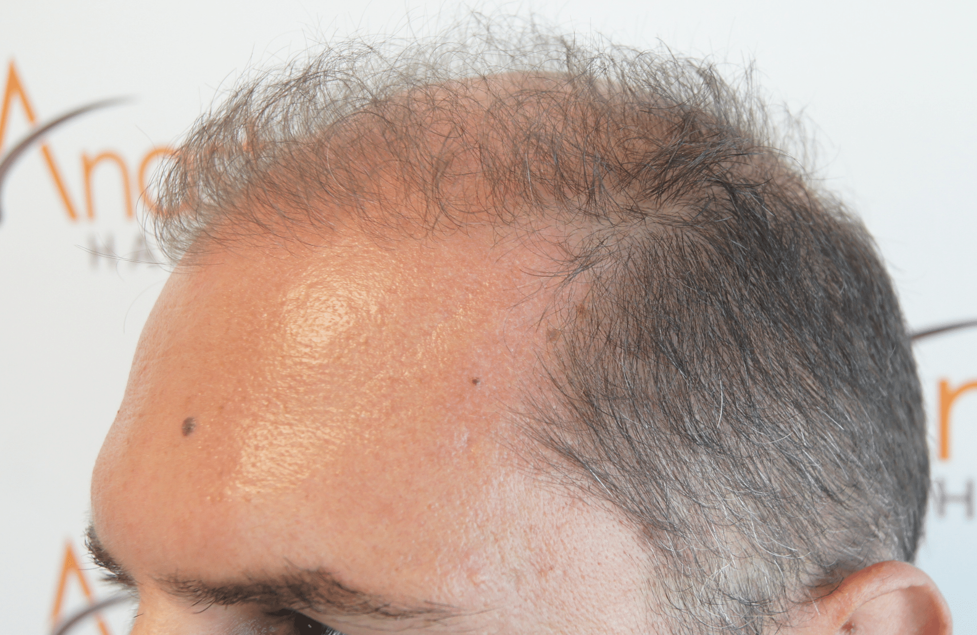 hair transplant result with 3000 follicular units anastasakis hair clinic