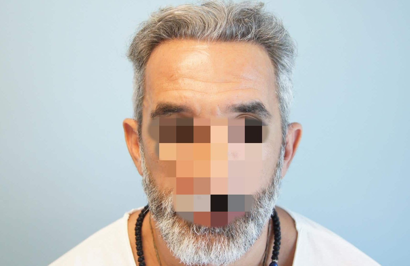 μεταμοσχευση μαλλιων πριν και μετα