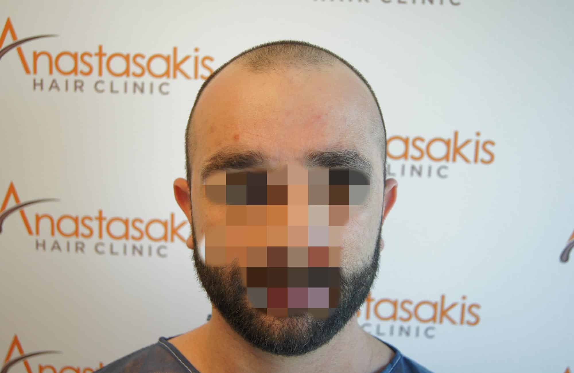 μεταμοσχευση μαλλιων πριν και μετα