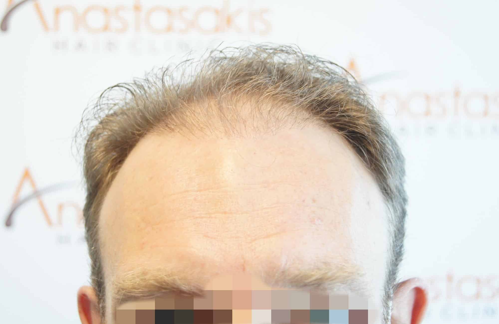 μεταμοσχευση μαλλιων πριν και μετα