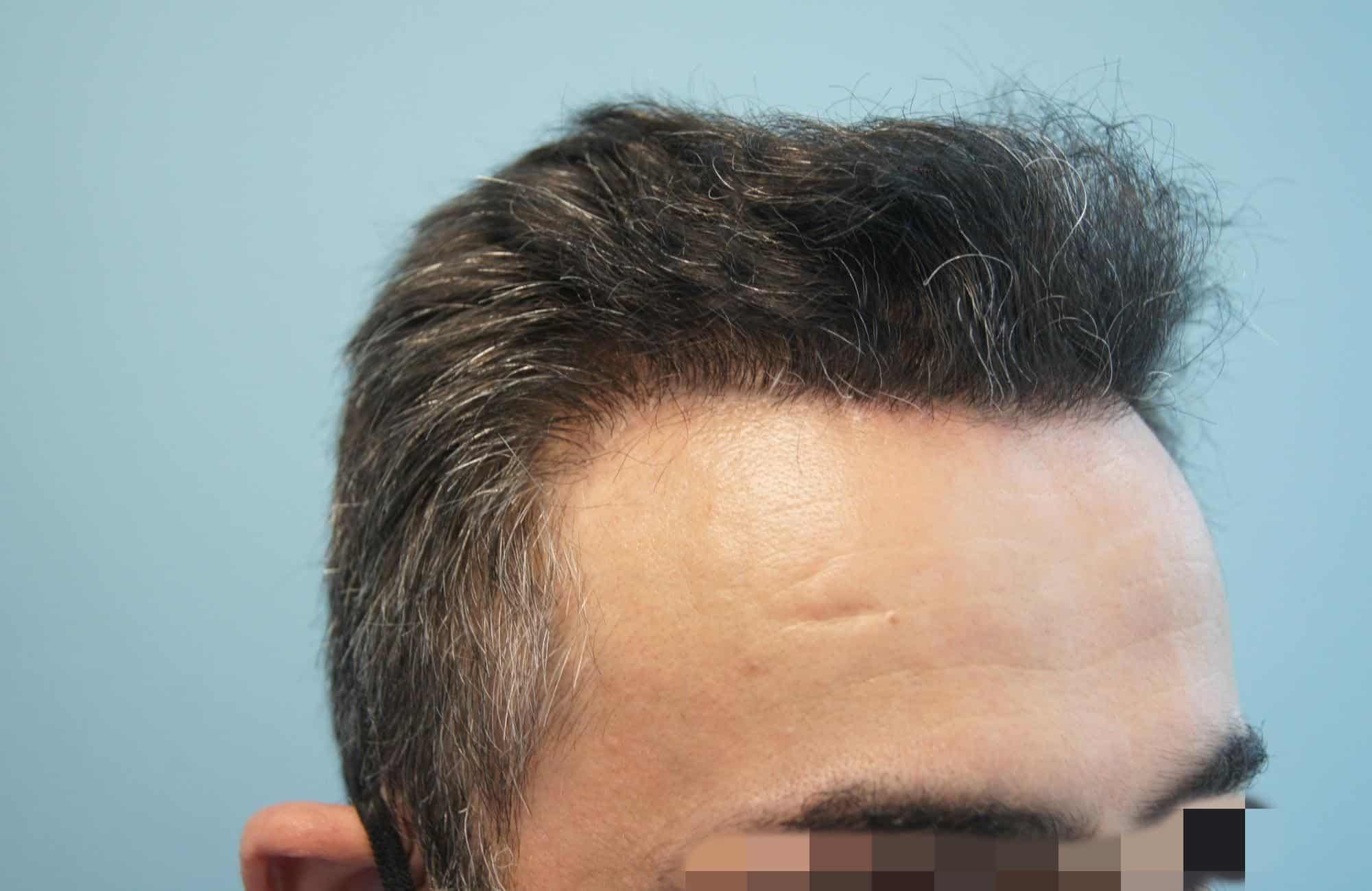μεταμοσχευση μαλλιων πριν και μετα