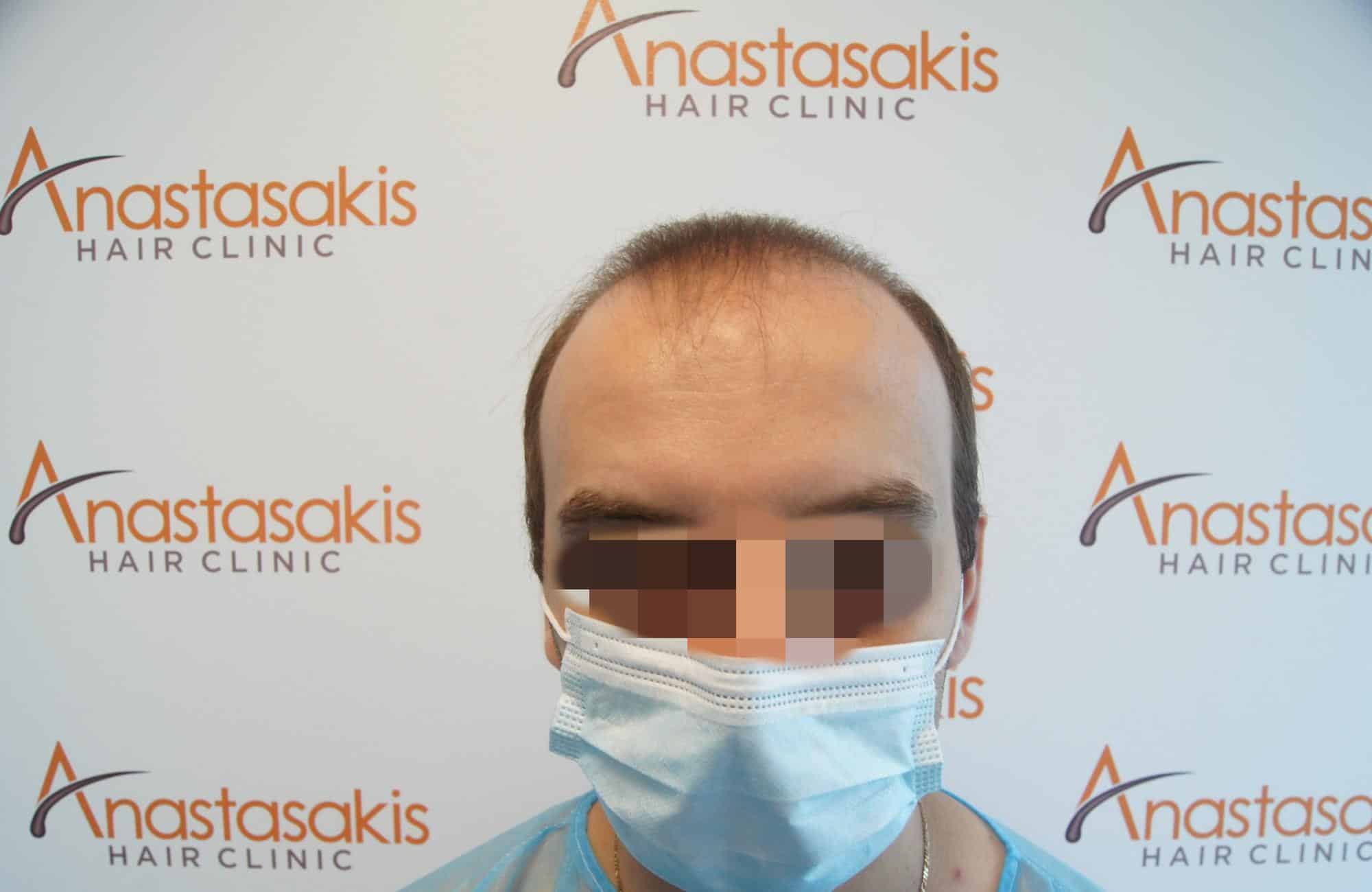 μεταμοσχευση μαλλιων πριν και μετα
