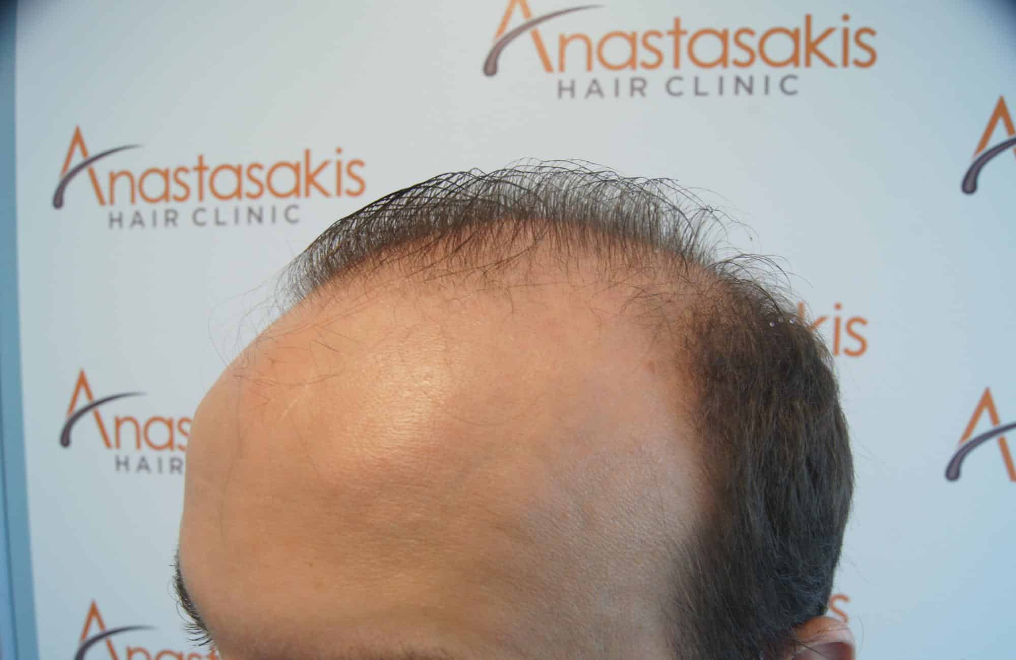 μεταμοσχευση μαλλιων πριν και μετα