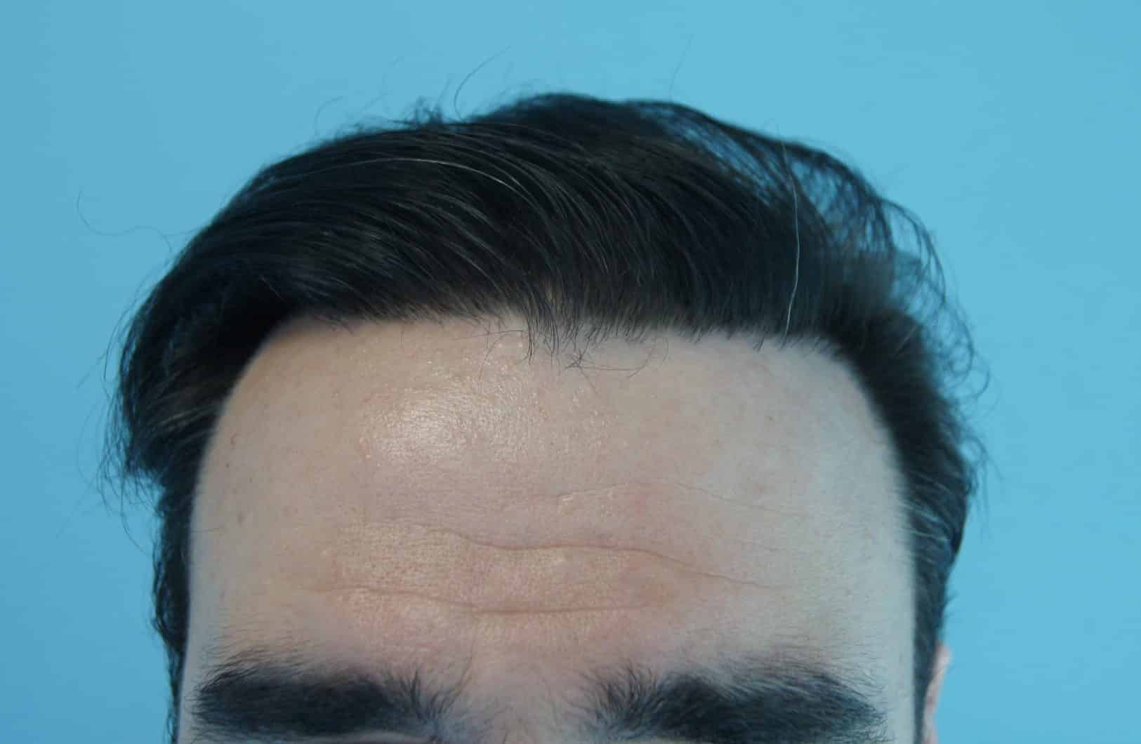 μεταμοσχευση μαλλιων πριν και μετα