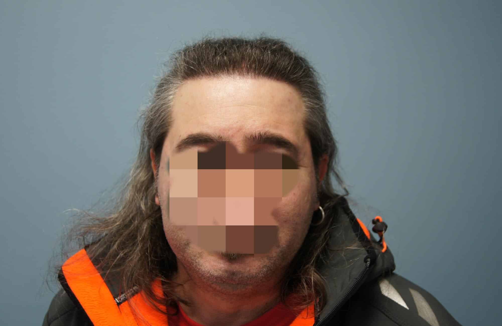 μεταμοσχευση μαλλιων πριν και μετα