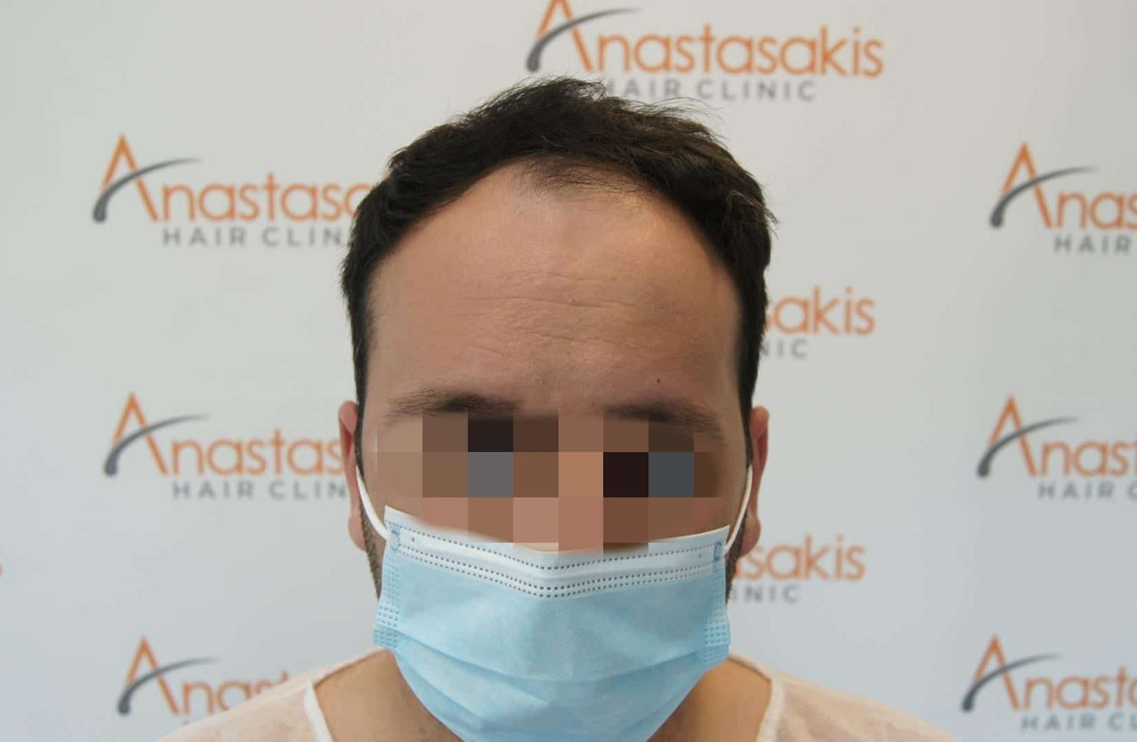 μεταμοσχευση μαλλιων πριν και μετα