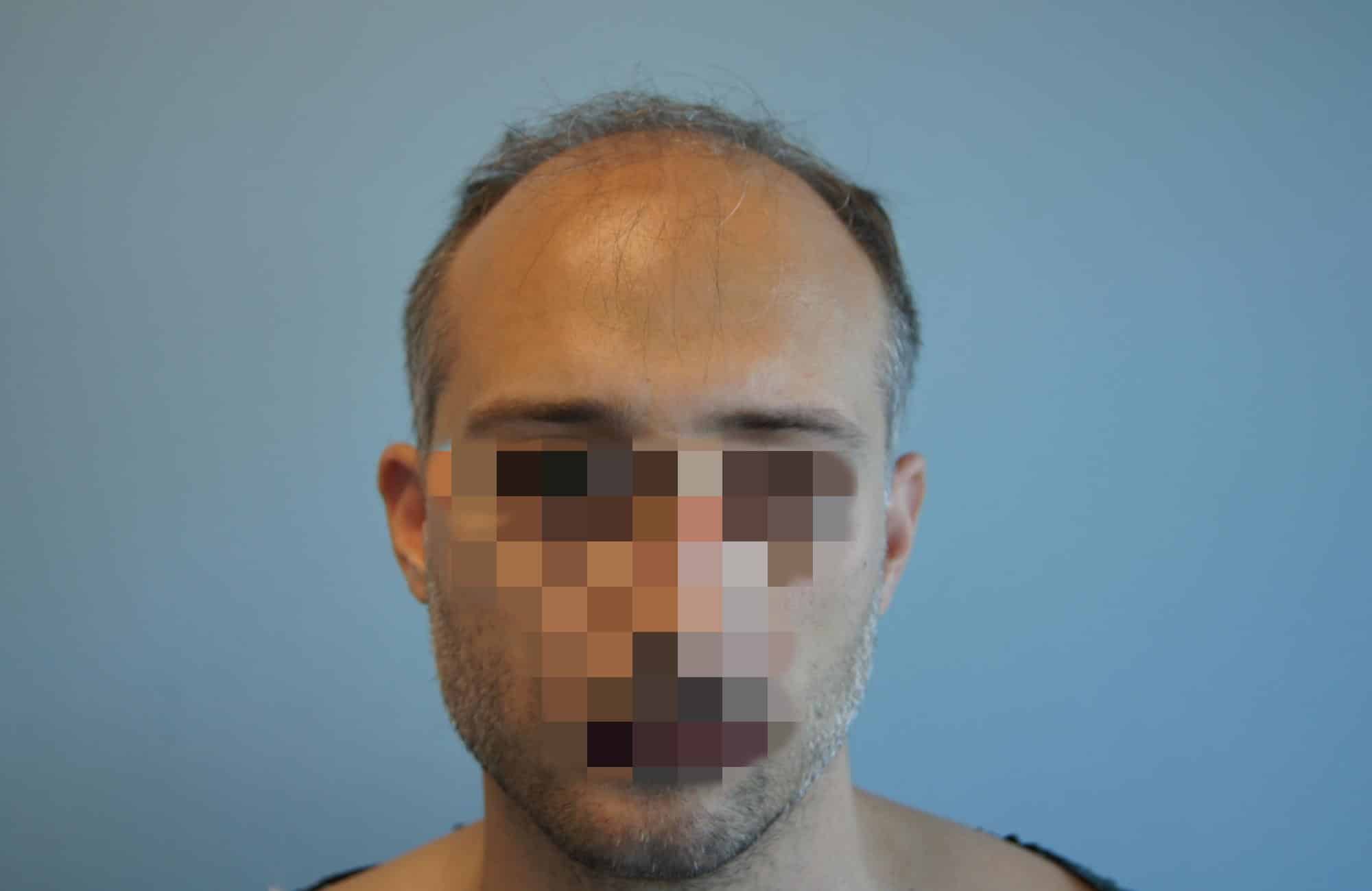 μεταμοσχευση μαλλιων πριν και μετα