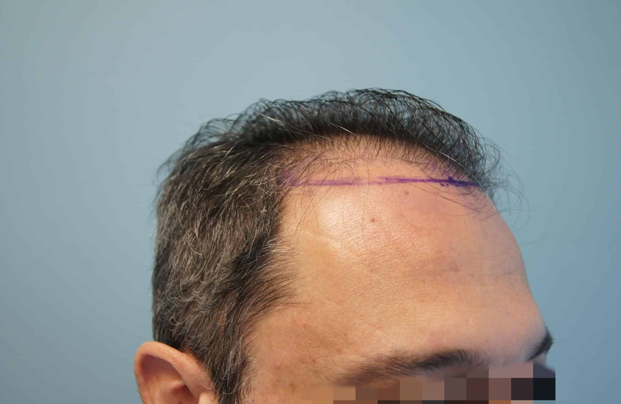 μεταμοσχευση μαλλιων πριν και μετα