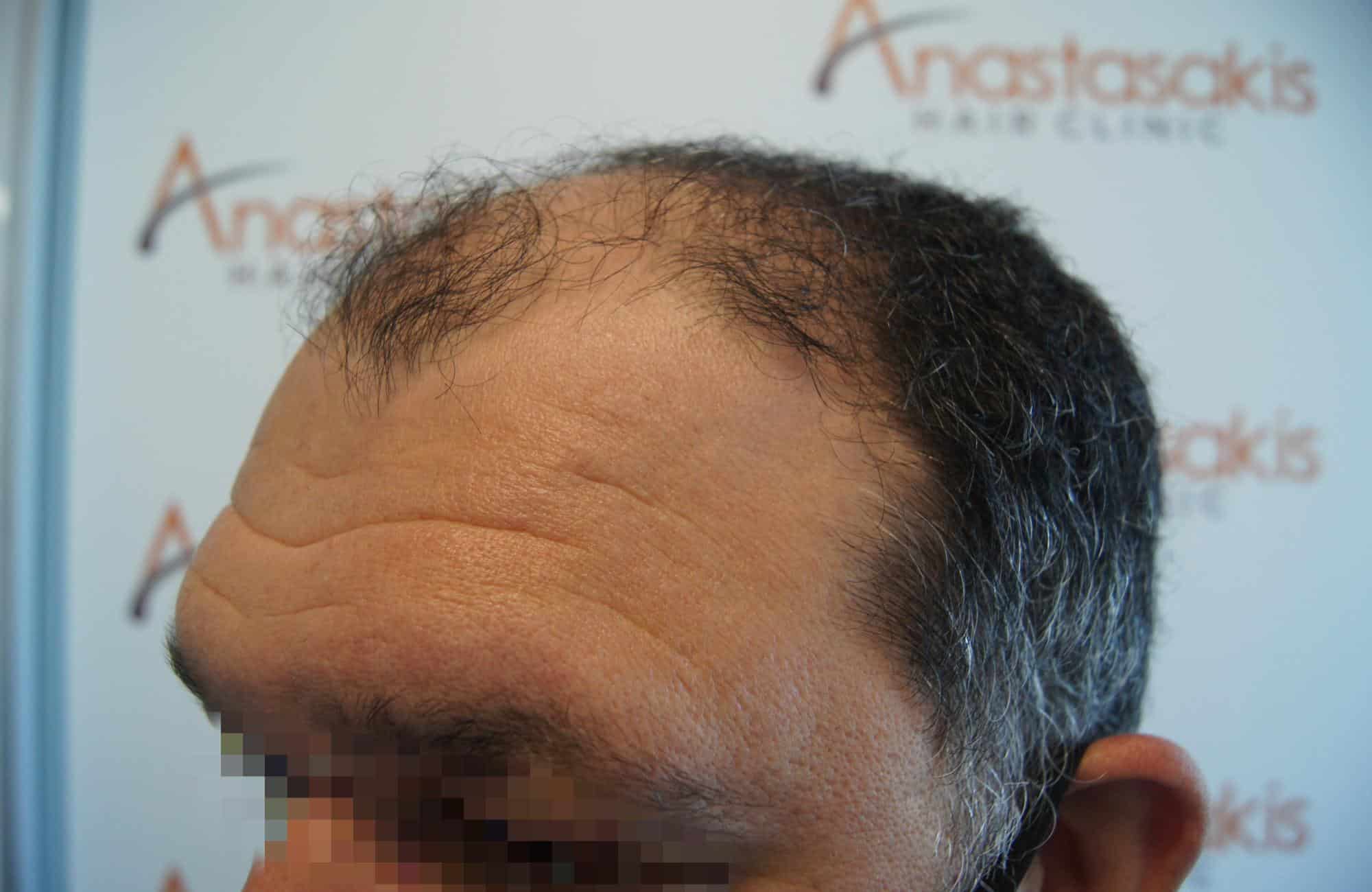 μεταμοσχευση μαλλιων πριν και μετα
