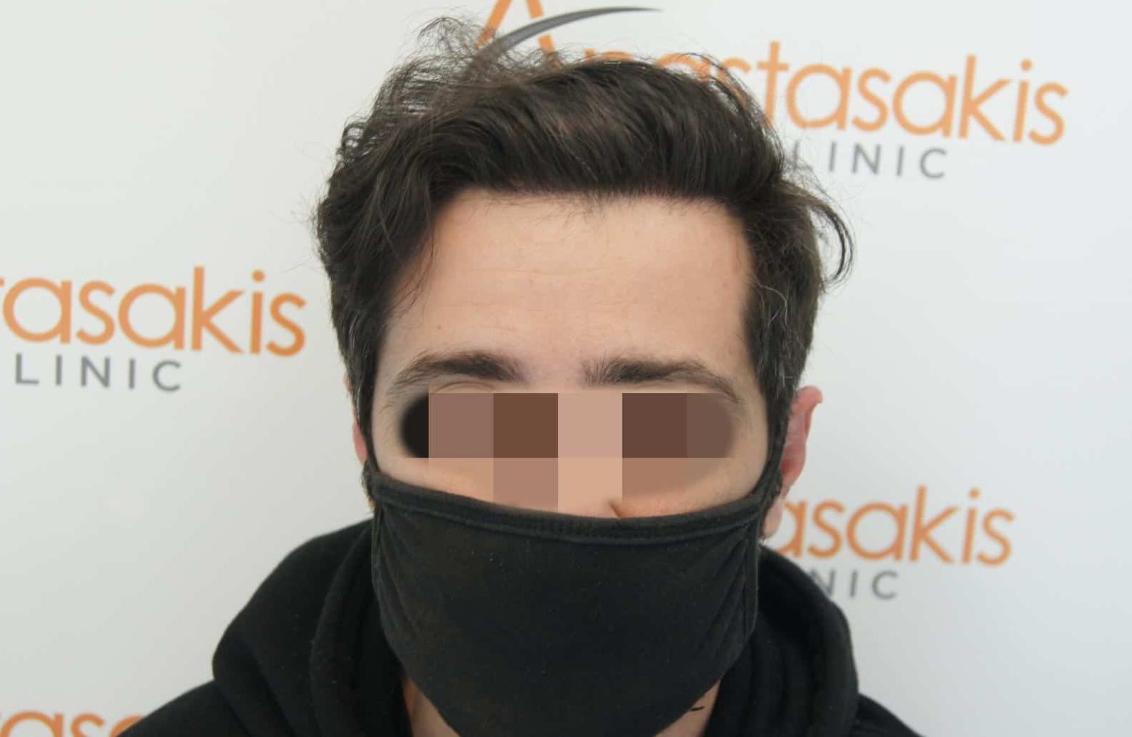 μεταμοσχευση μαλλιων πριν και μετα