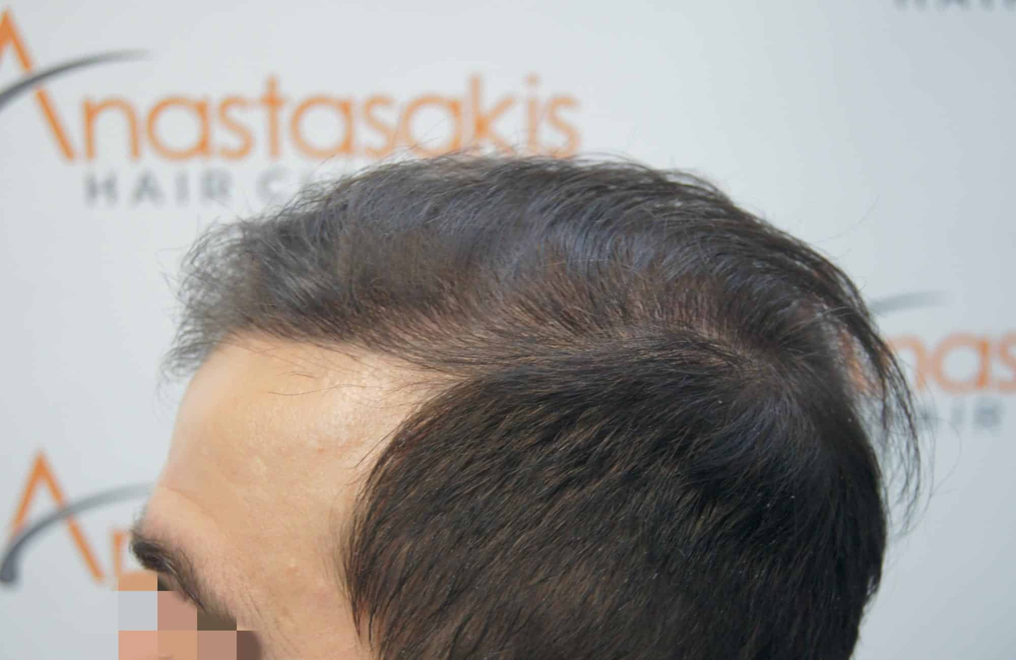 μεταμοσχευση μαλλιων πριν και μετα