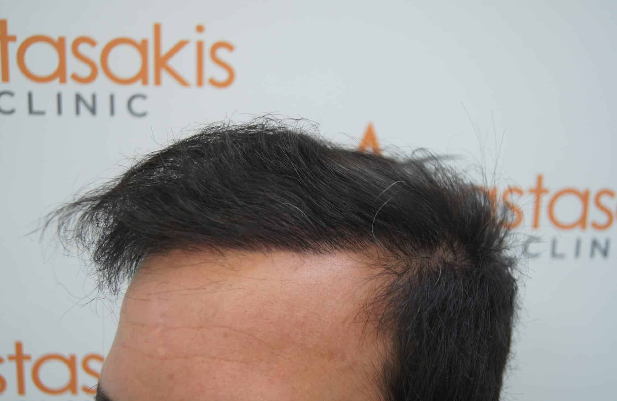 μεταμοσχευση μαλλιων πριν και μετα