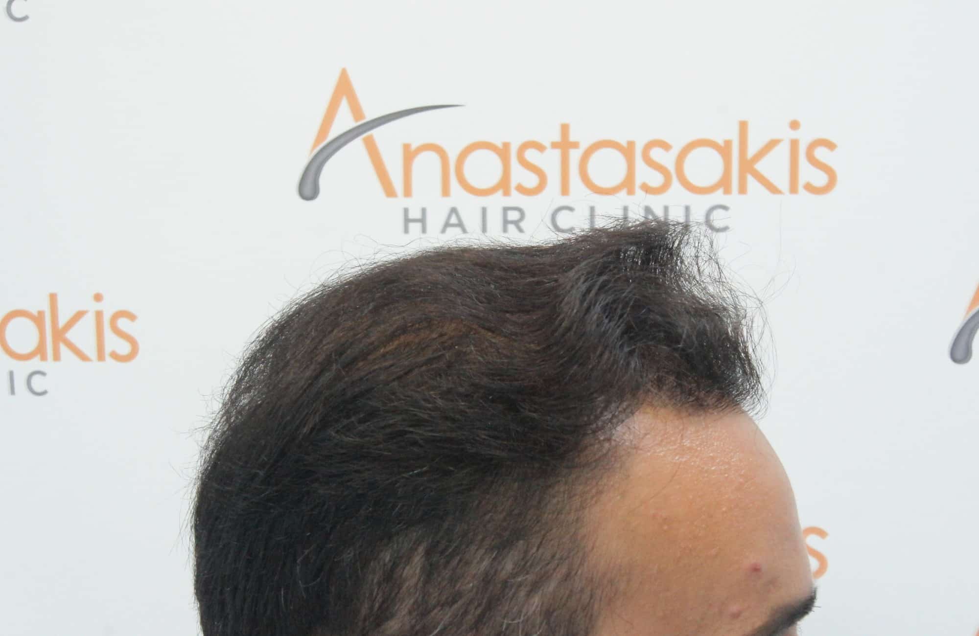 μεταμοσχευση μαλλιων πριν και μετα