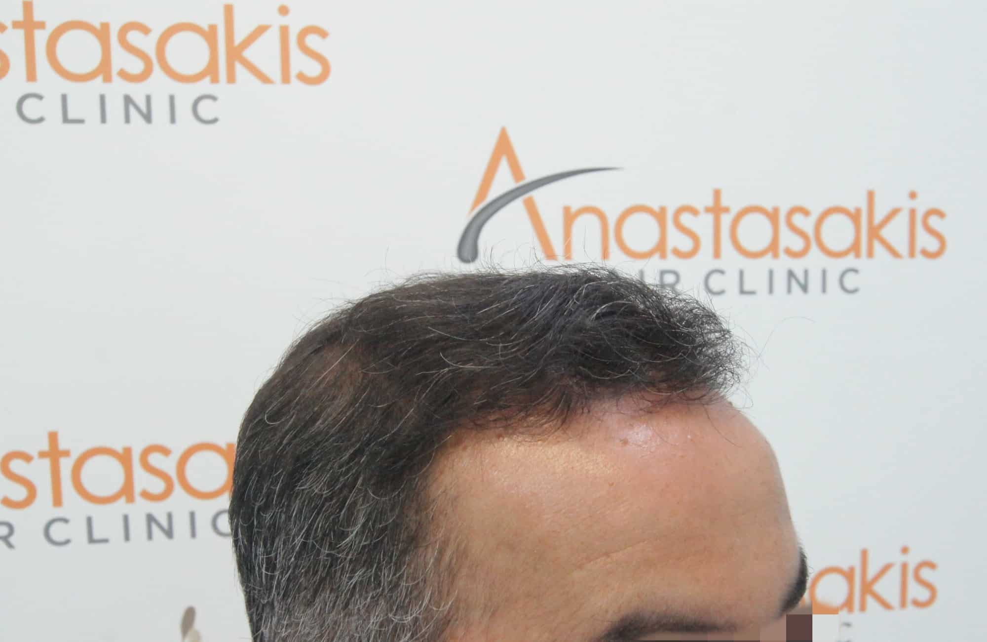 μεταμοσχευση μαλλιων πριν και μετα