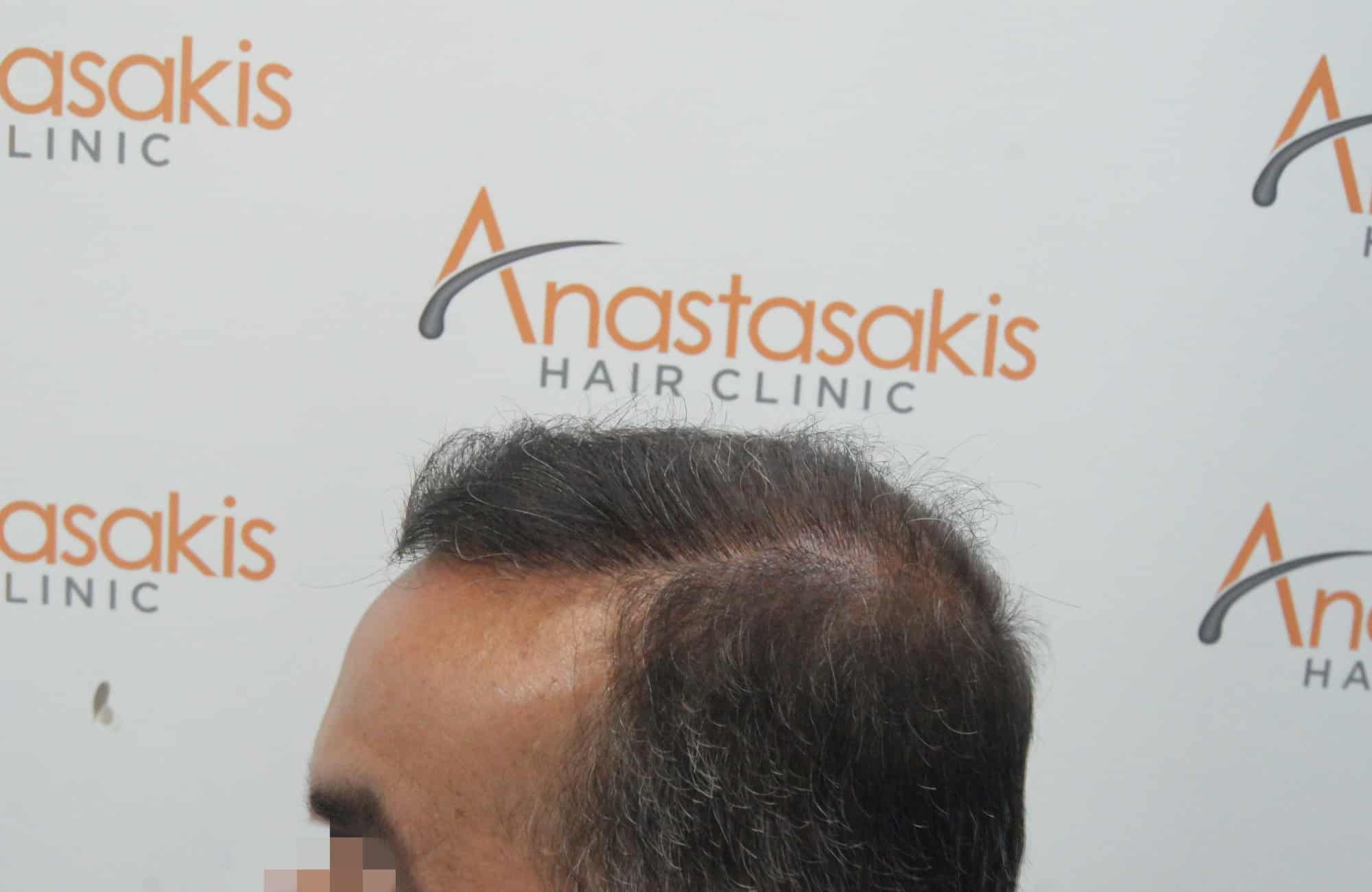μεταμοσχευση μαλλιων πριν και μετα