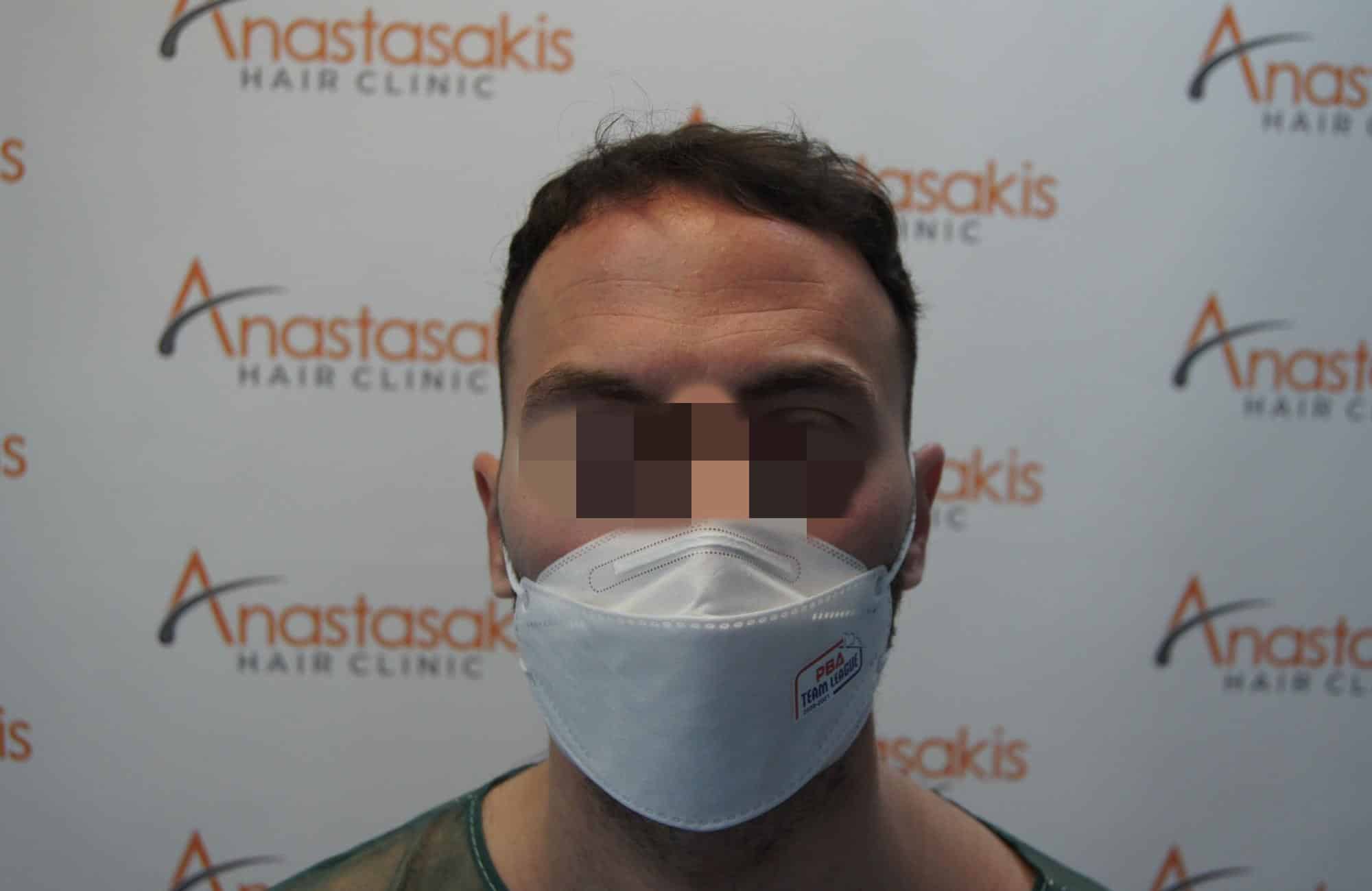 μεταμοσχευση μαλλιων πριν και μετα