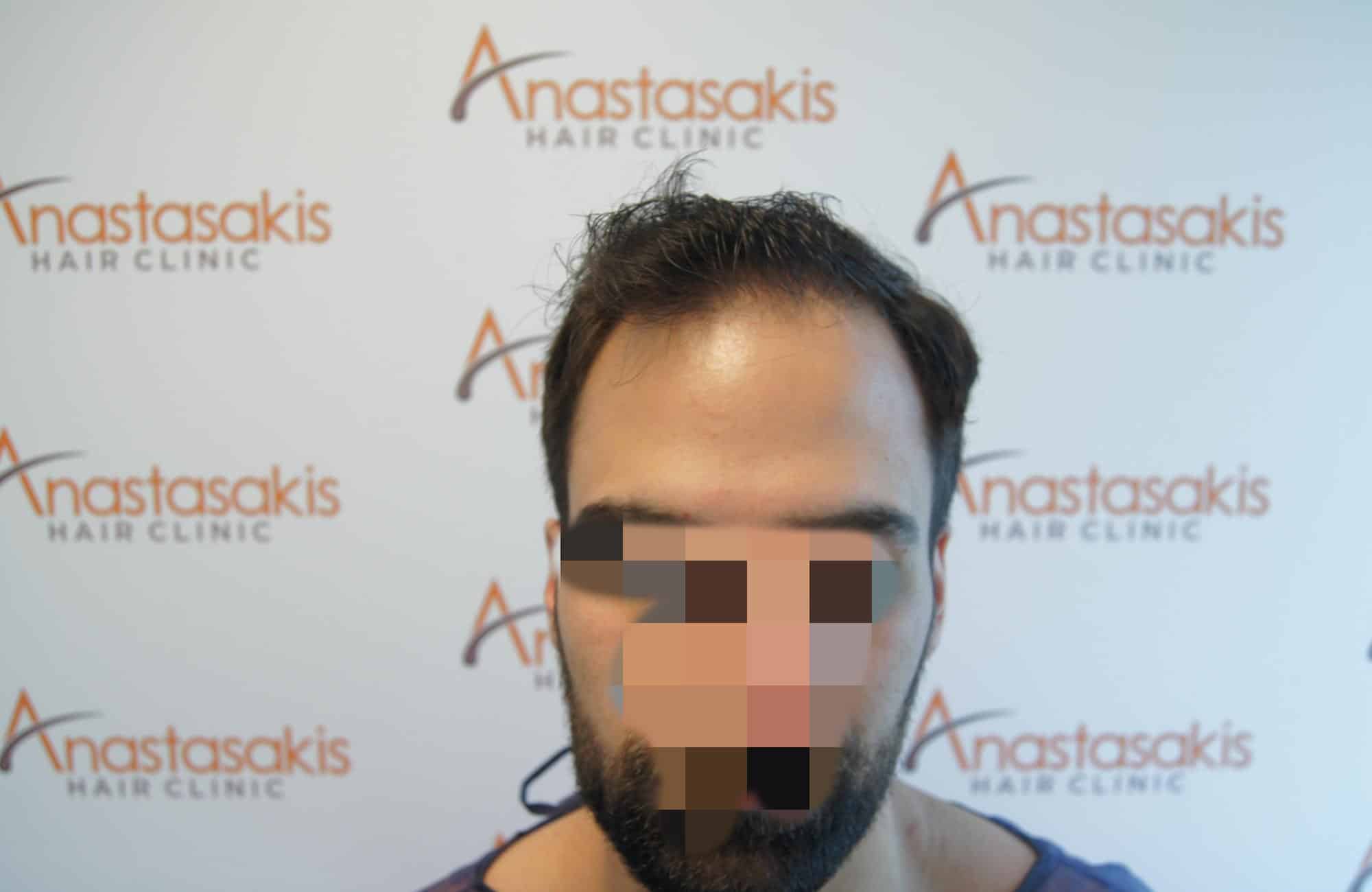 μεταμοσχευση μαλλιων πριν και μετα
