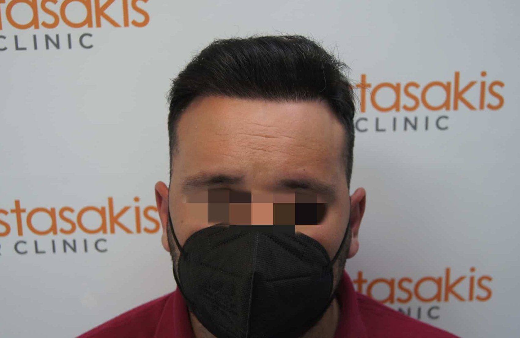 μεταμοσχευση μαλλιων πριν και μετα
