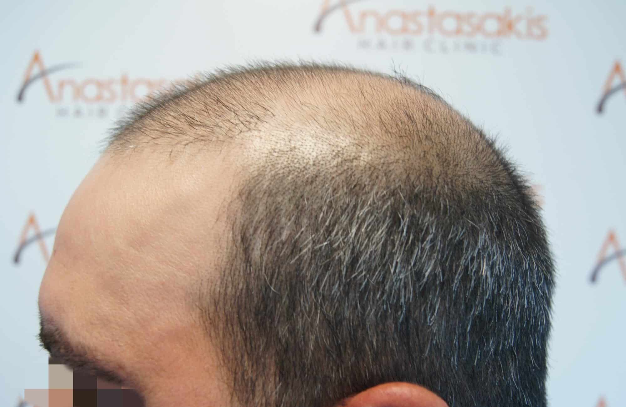 μεταμοσχευση μαλλιων πριν και μετα