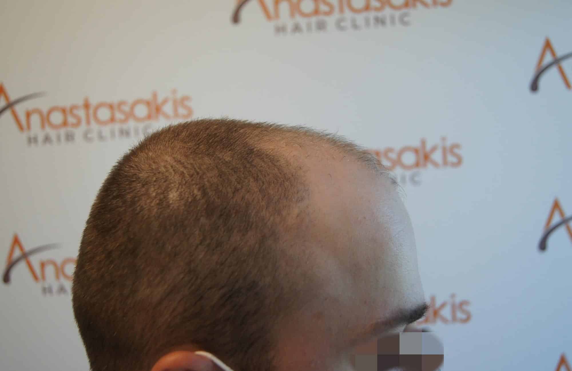 μεταμοσχευση μαλλιων πριν και μετα