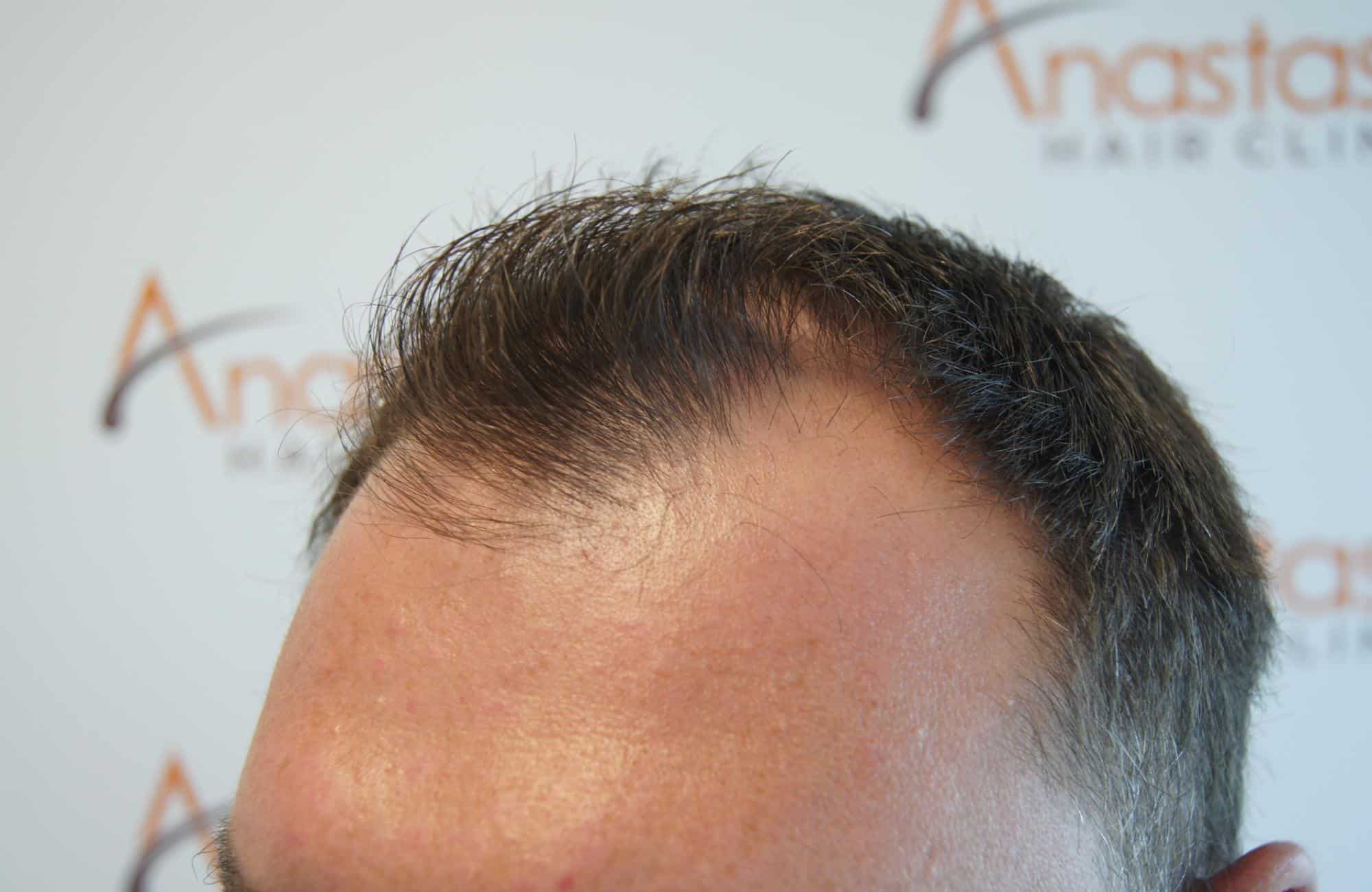 μεταμοσχευση μαλλιων πριν και μετα