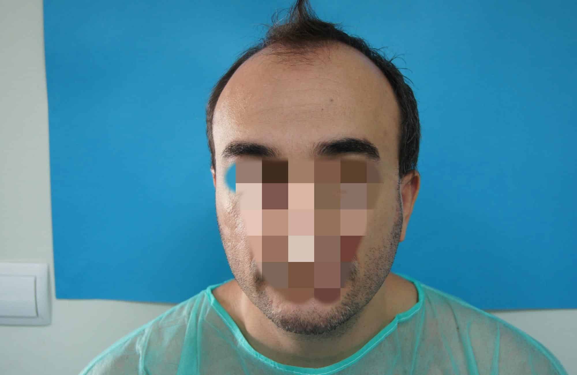 https://anastasakishairclinic.com/portfolio/apotelesma-metamosxefsis-mallion-anastasakis-hair-clinic-170/