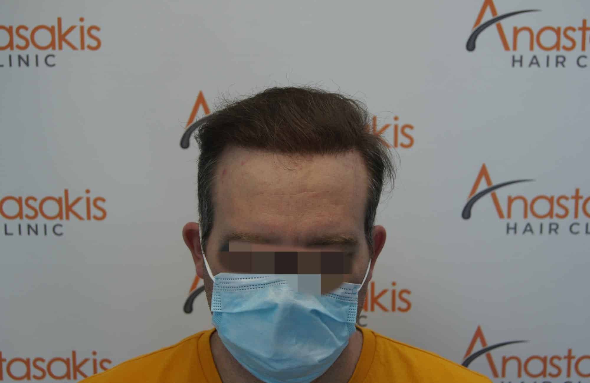μεταμοσχευση μαλλιων πριν και μετα