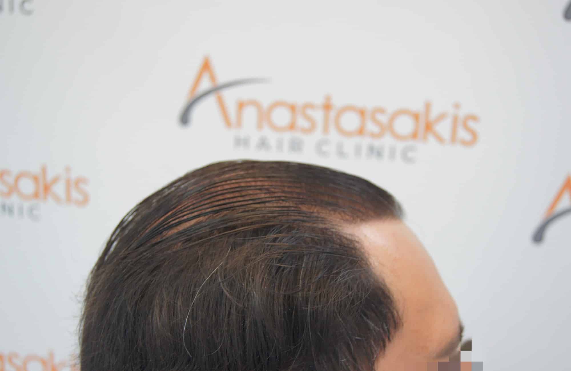 μεταμοσχευση μαλλιων πριν και μετα