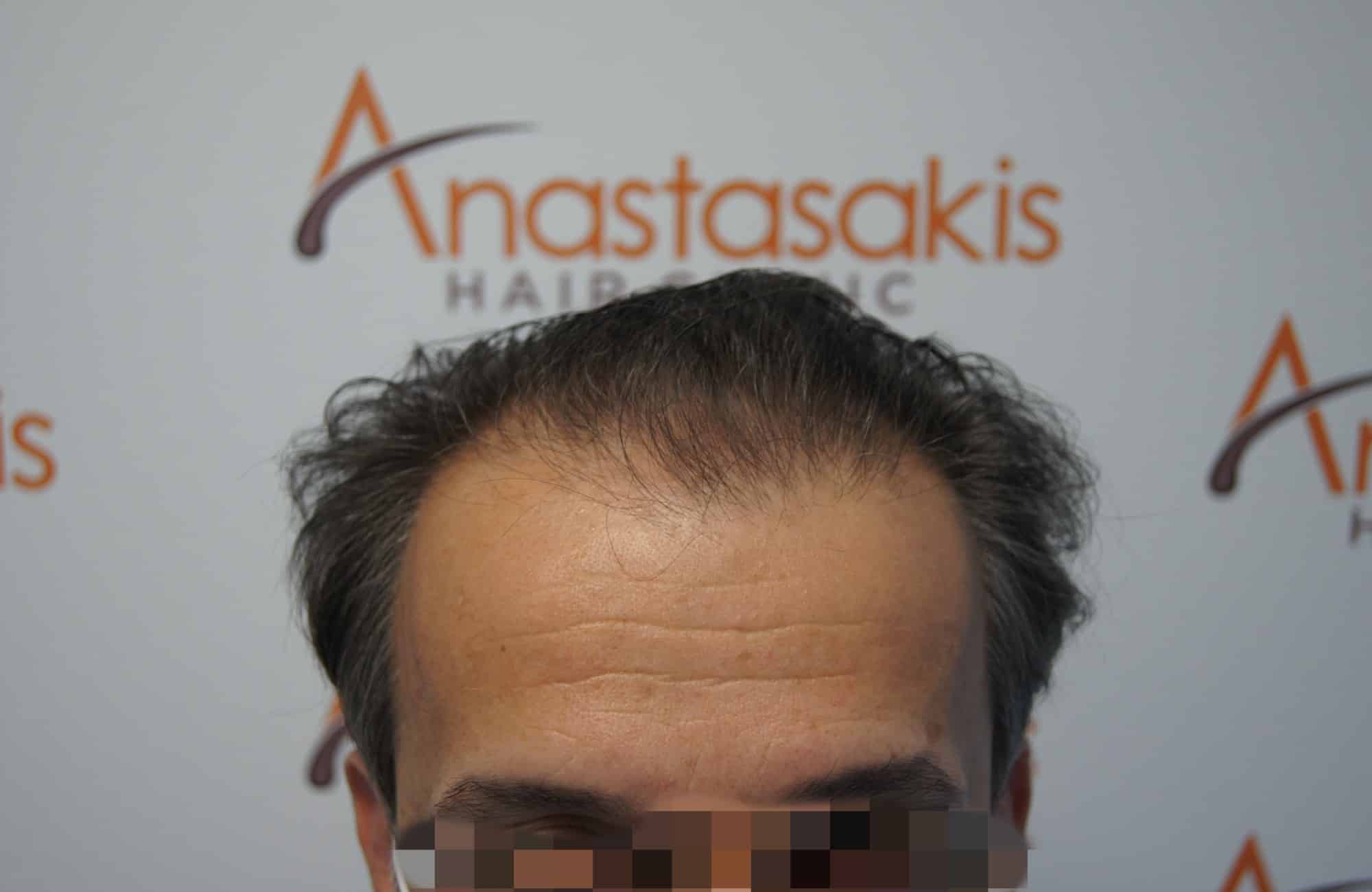 μεταμοσχευση μαλλιων πριν και μετα