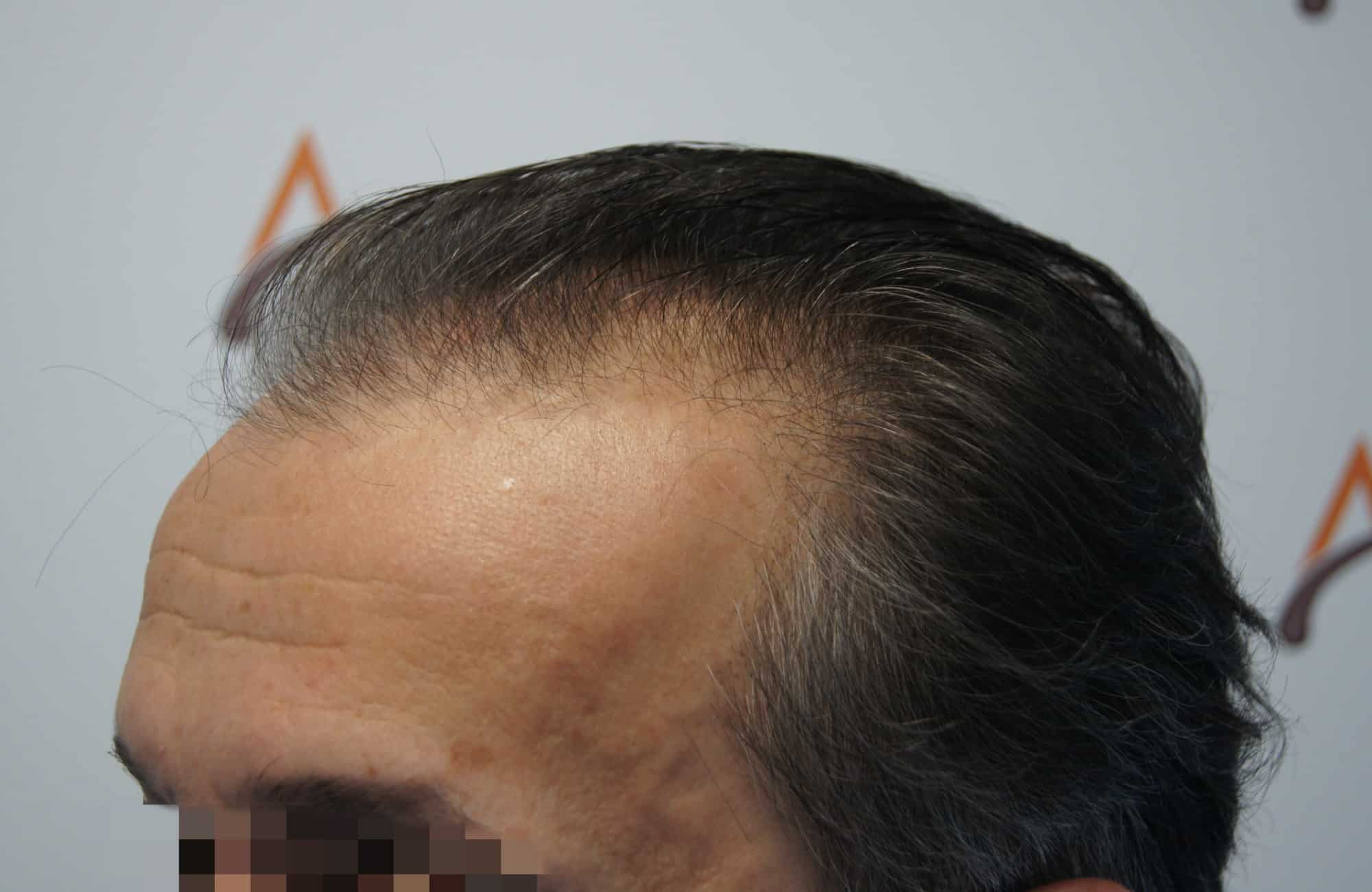 μεταμοσχευση μαλλιων πριν και μετα