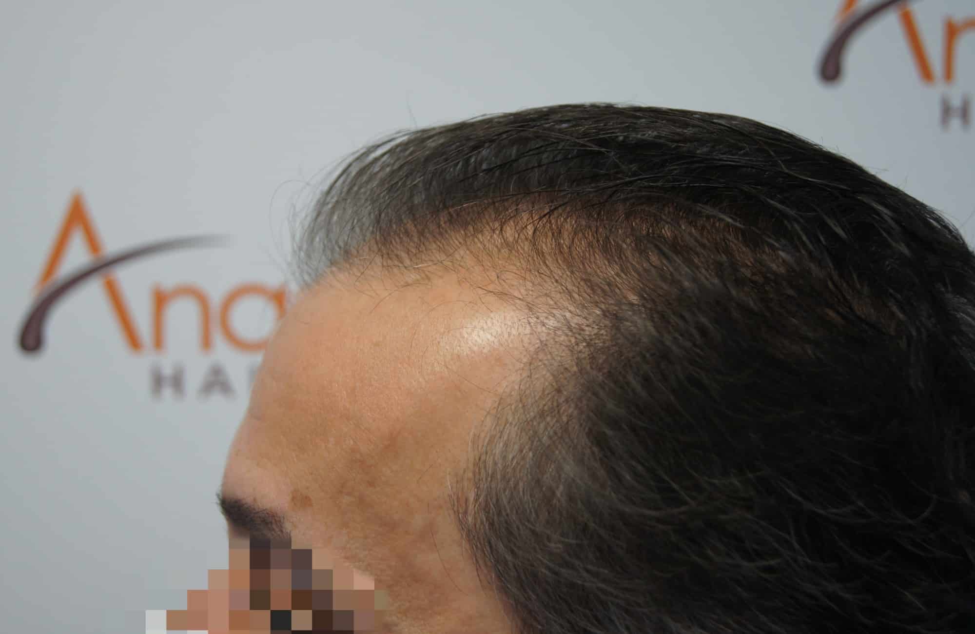 μεταμοσχευση μαλλιων πριν και μετα