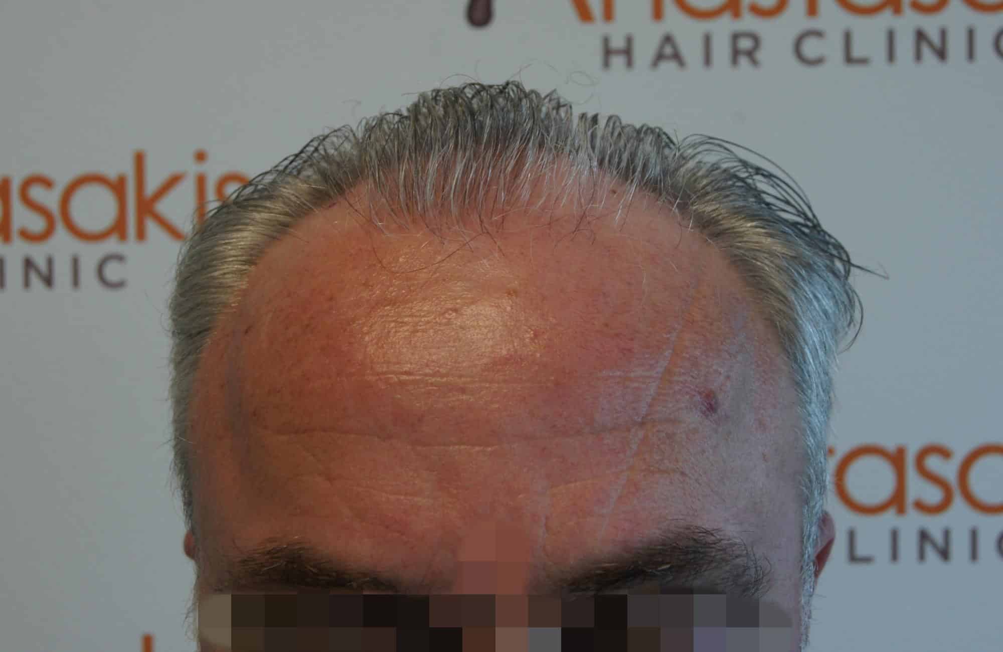 μεταμοσχευση μαλλιων πριν και μετα