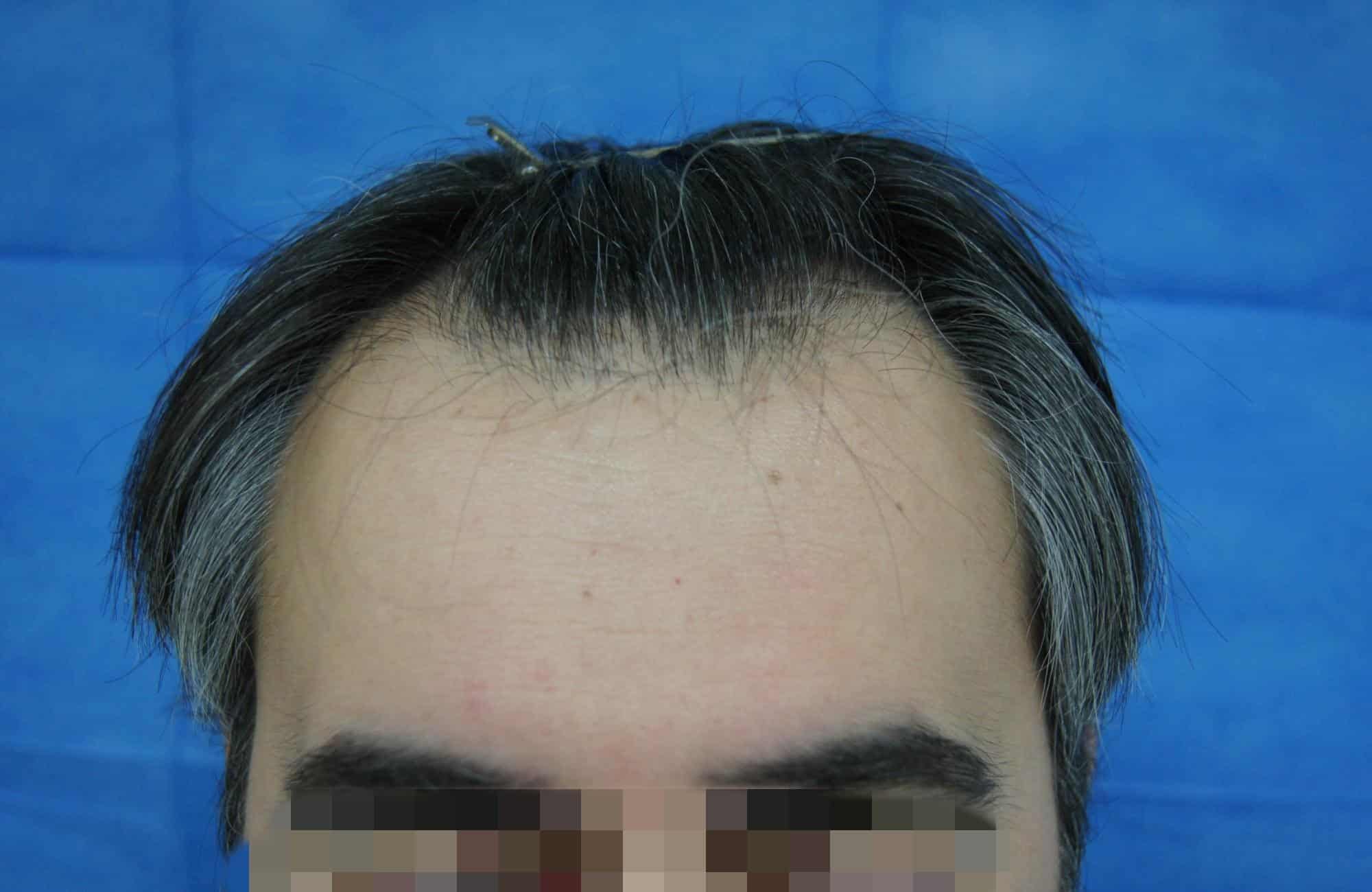 μεταμοσχευση μαλλιων πριν και μετα