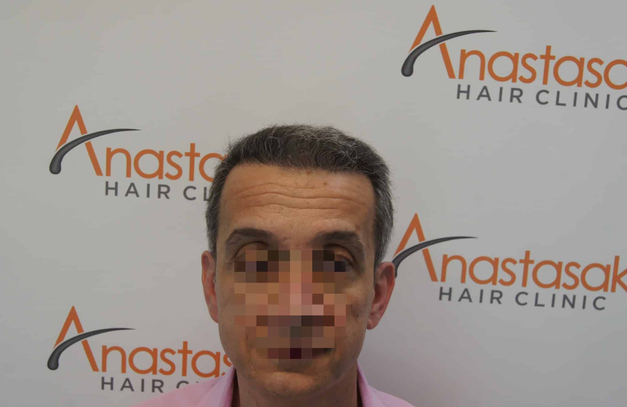 μεταμοσχευση μαλλιων πριν και μετα