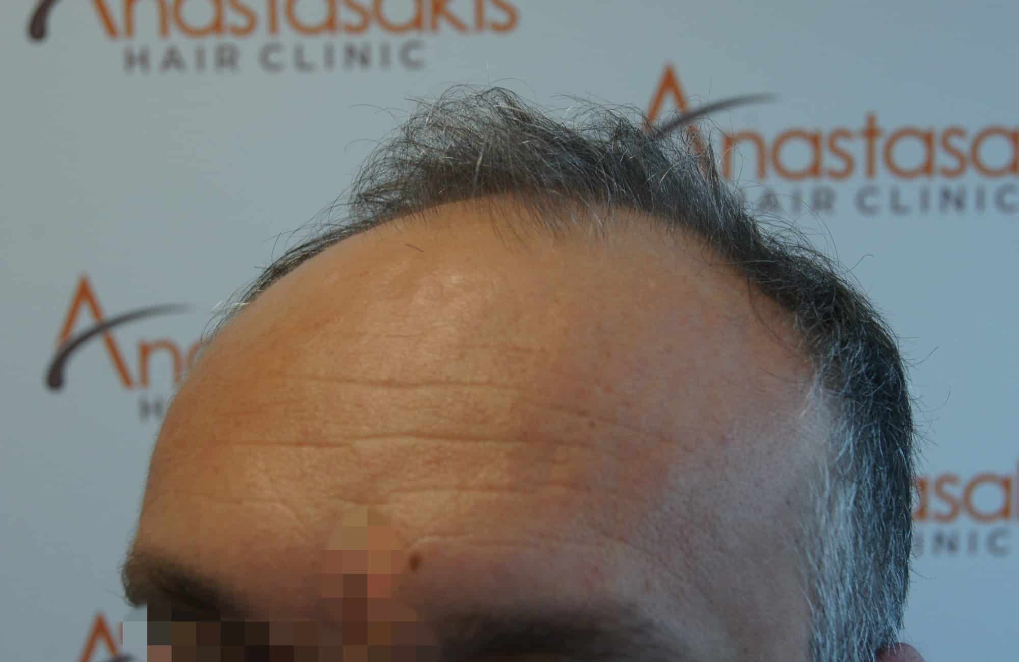 μεταμοσχευση μαλλιων πριν και μετα