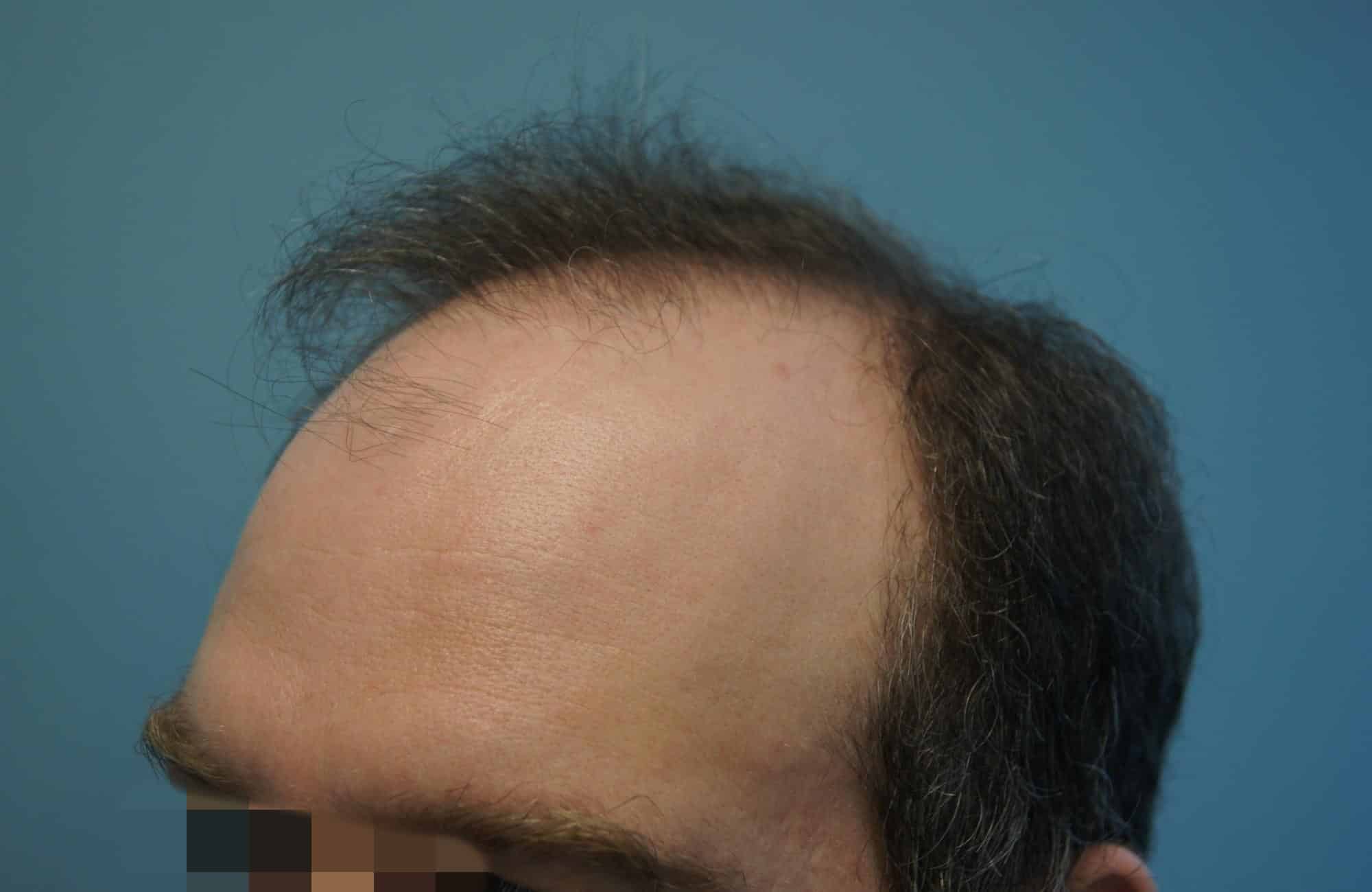 μεταμοσχευση μαλλιων πριν και μετα