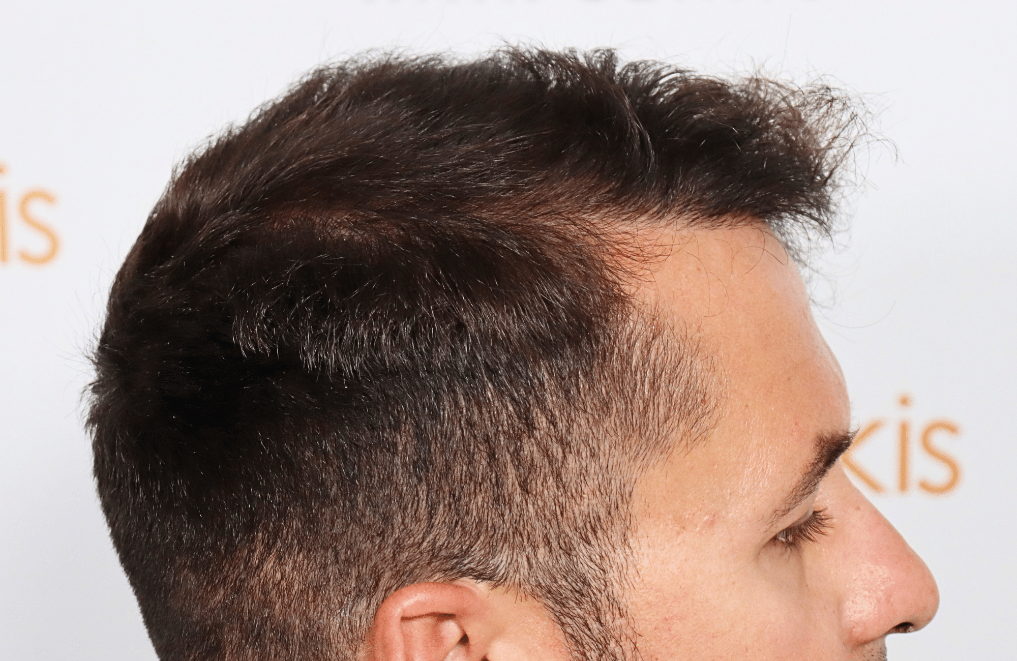 HAIR TRANSPLANT RESULT 2600 FUS STAGE 4 (4)