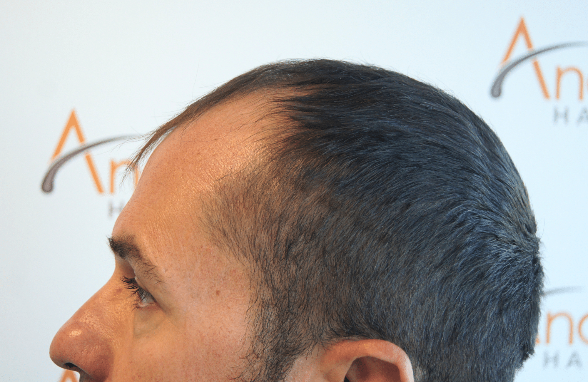 HAIR TRANSPLANT RESULT 2600 FUS STAGE 4 (5)