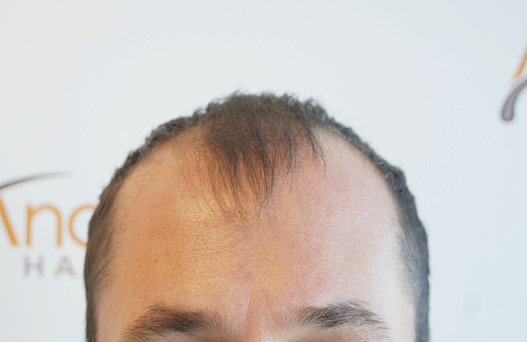 HAIR TRANSPLANT RESULT 2600 FUS STAGE 4 (7)