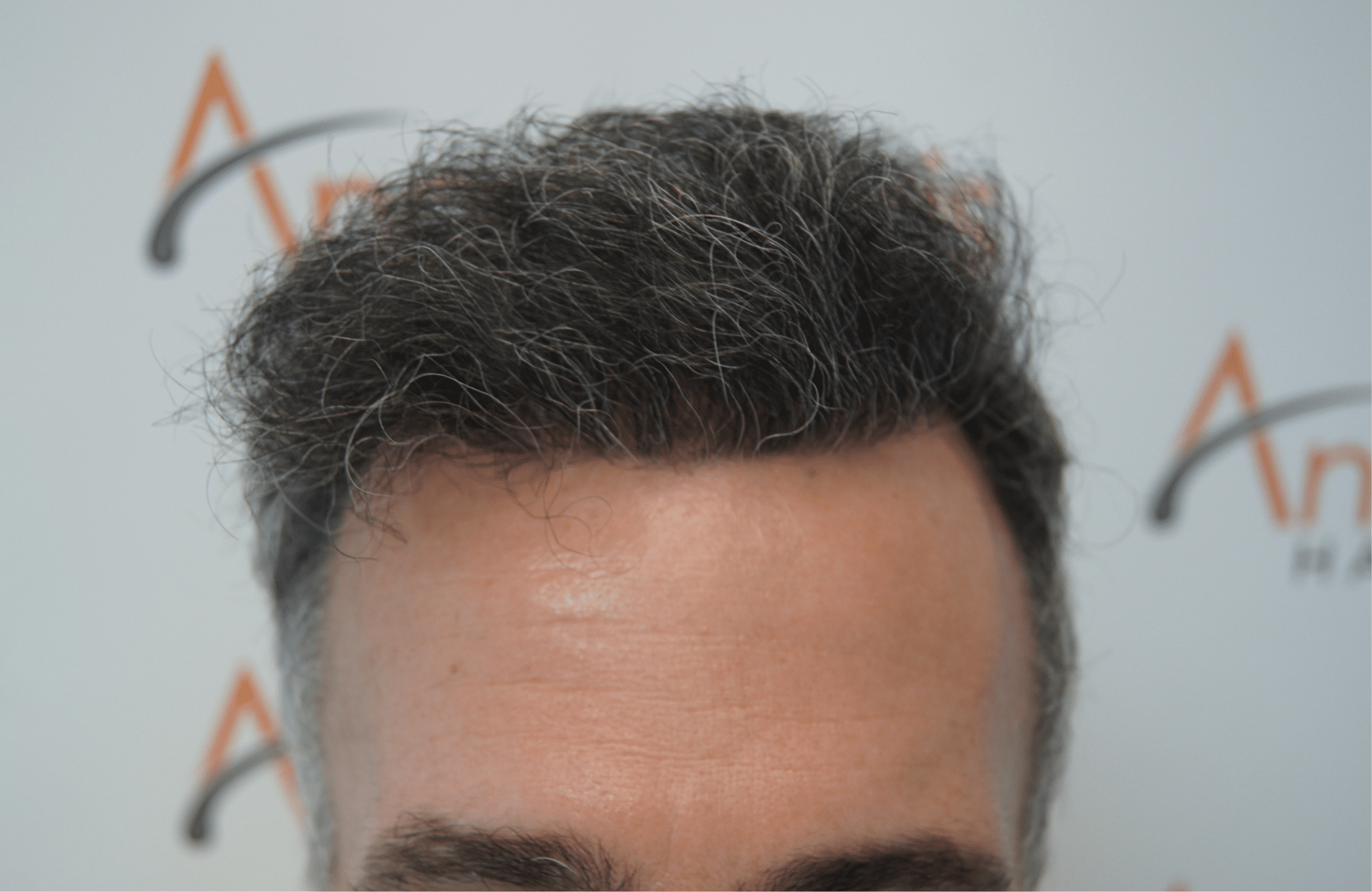 peristatiko meta ti metamosxefsi mallion me 3500 fus hairline